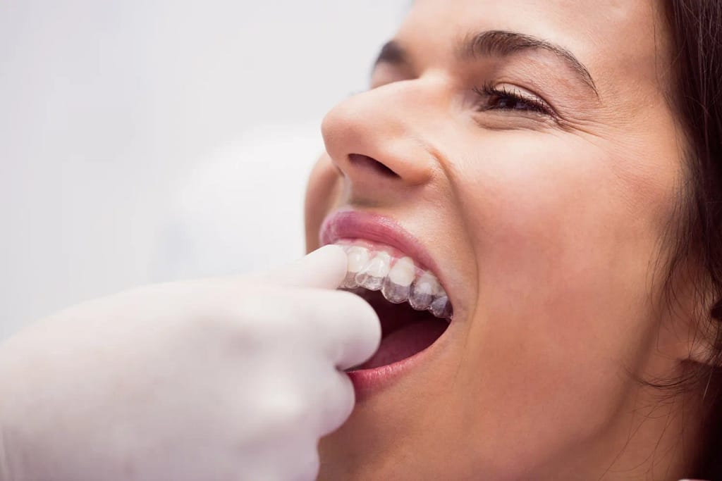 Invisalign Slough