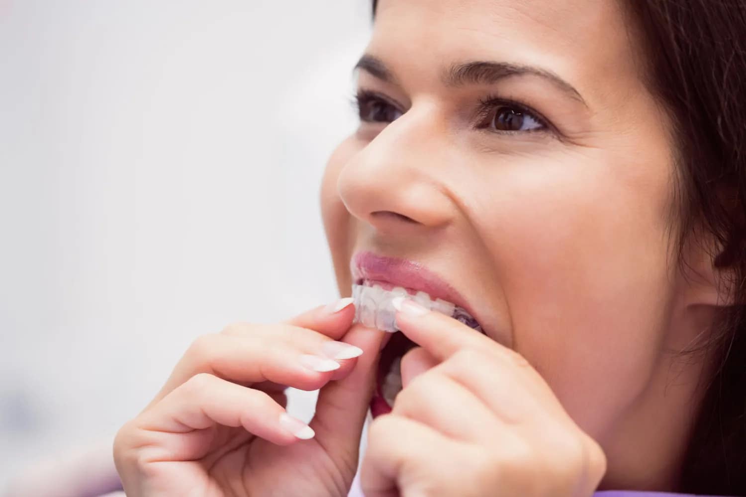 Woman wearing Invisalign aligners