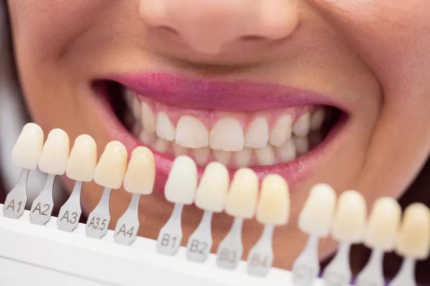 Composite bonding seamless results